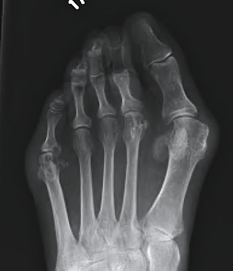 Rheumatoid Forefoot Hallux Valgus